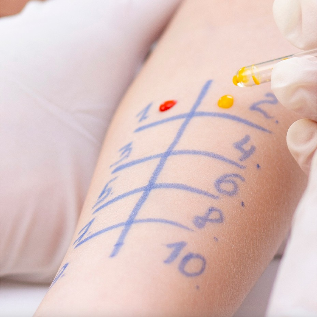 pruebas cutaneas para alergia en piel